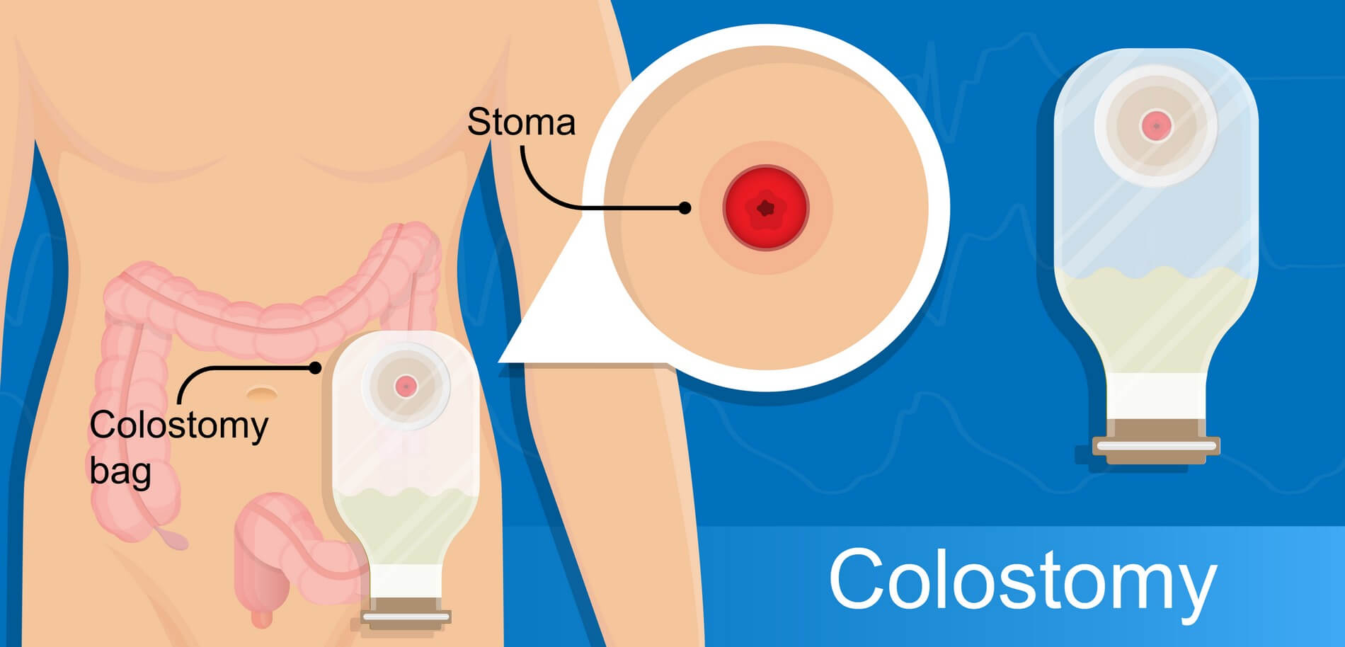 colostomie