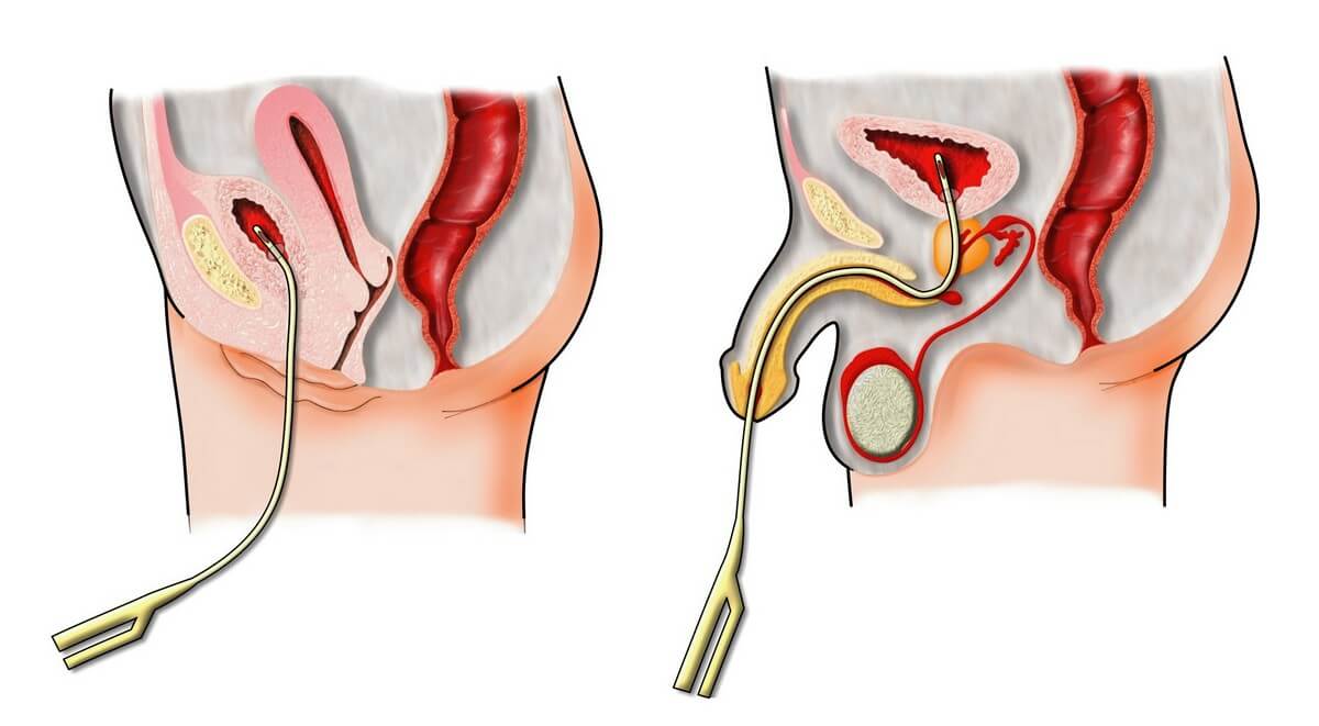 sonde urinare osteocondroză sau prostatita